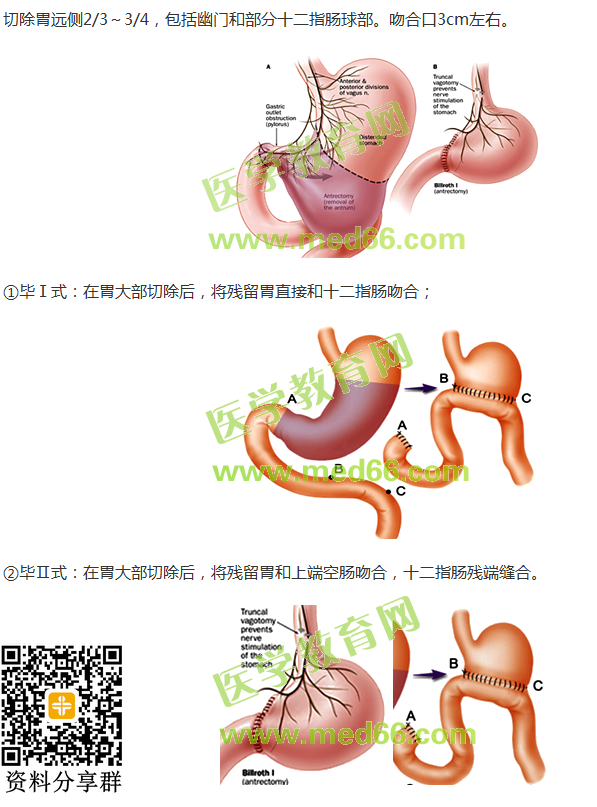 胃大部切除術(shù)